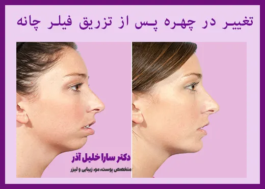 قبل و بعد از تزریق فیلر چانه