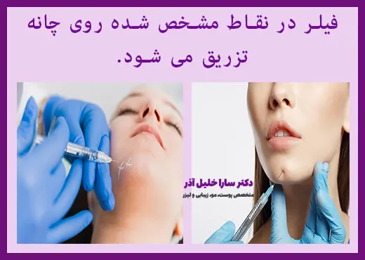 روش تزریق فیلر چانه