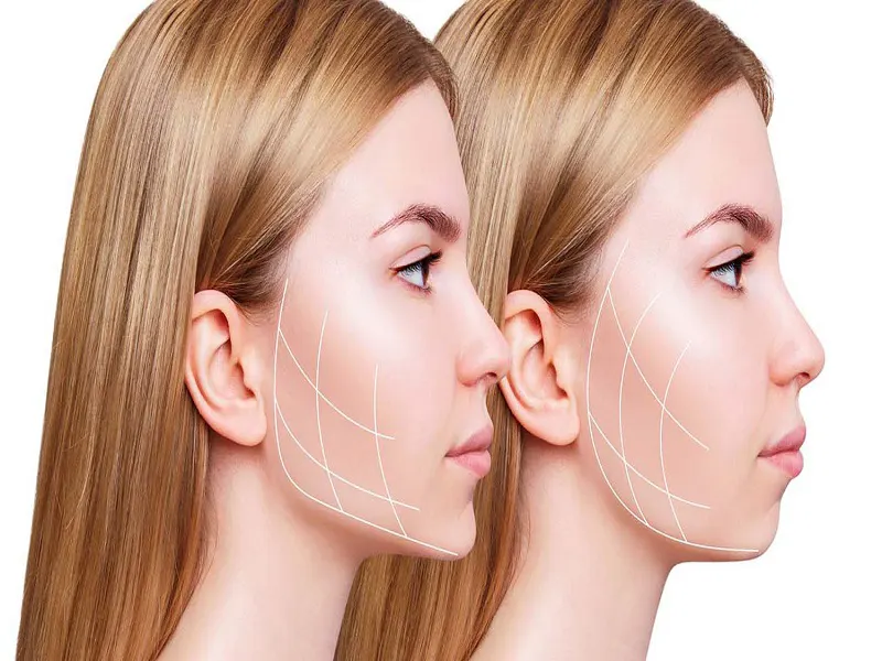 تزریق فیلر زاویه فک