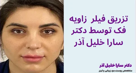 تزریق فیلر زاویه فک توسط دکتر سارا خلیل آذر