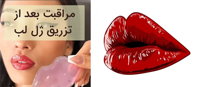 مراقبت های ژل لب