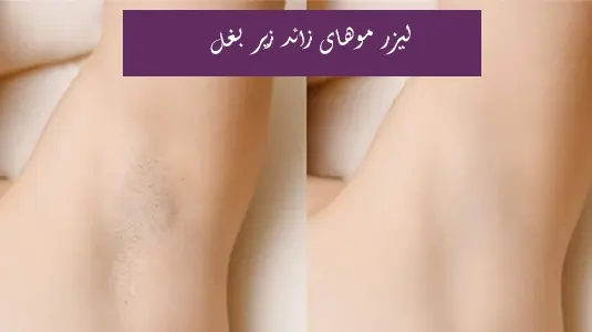 لیزر موهای زائد زیر بغل