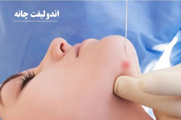 اندولیفت چانه
