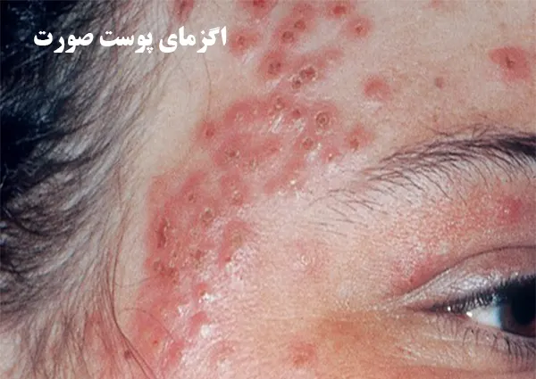 اگزمای پوست صورت