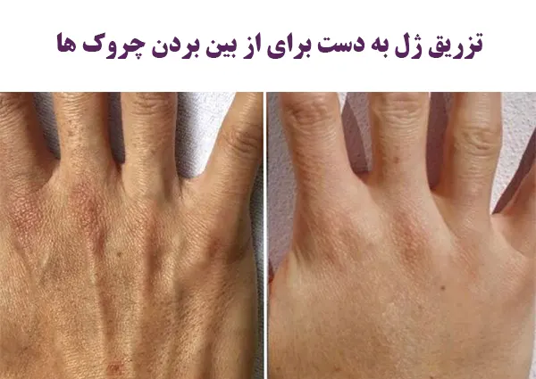 تزریق ژل  دست