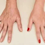 تزریق ژل دست