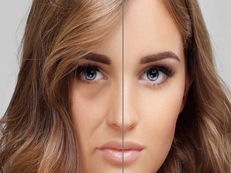بالاکشیدن صورت میدفیس