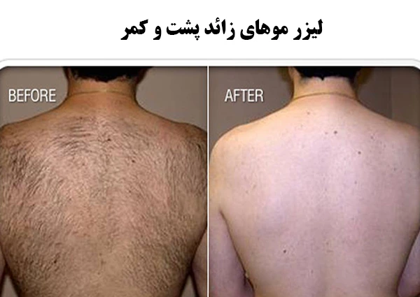 لیزر موهای زائد پشت و کمر