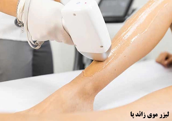 لیزر موی زائد کل پا