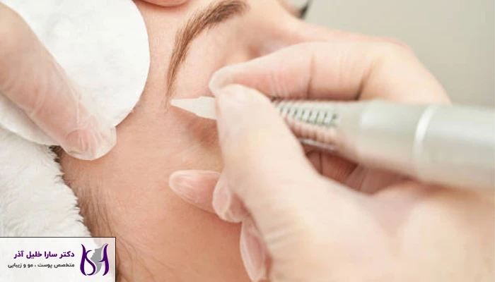 مزوتراپی ابرو چیست؟