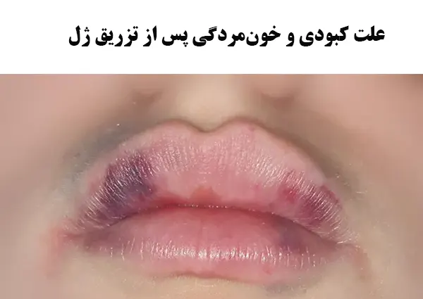 خون‌مردگی پس از تزریق ژل