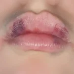 کبودی بعد ژل لب