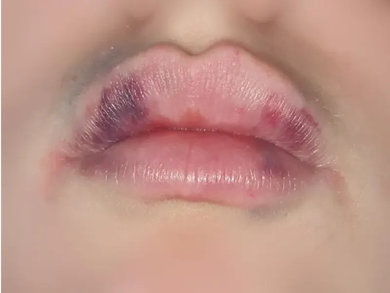 کبودی بعد ژل لب